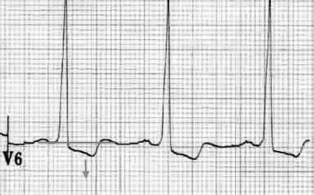 lv strain on ekg.